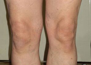 Dopo un ciclo di utilizzo di Osteflex, le articolazioni tornano alla normalità