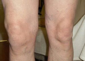 Prima di usare Osteflex, le ginocchia di Nils erano gonfie alla fine della giornata.